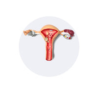 Fibroid Uterus