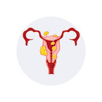 Leucorrhoea